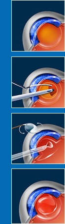 Cataract Surgery