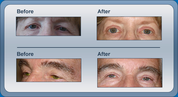 Blepharoplasty