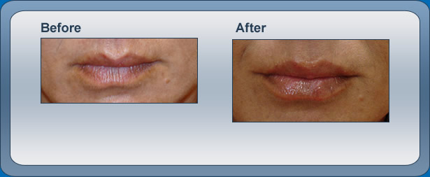 Lip Augmentation