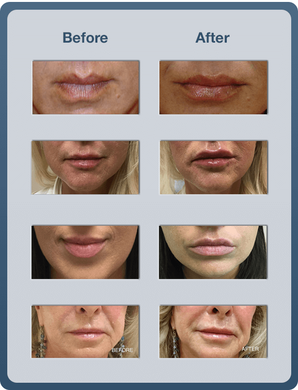 Lip Augmentation