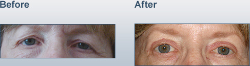 blepharoplasty