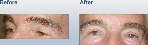 blepharoplasty