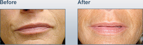 Juvederm