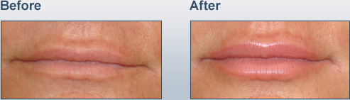 Lip Augmentation