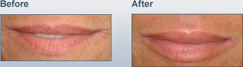 Lip Augmentation