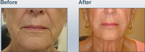 30 Minute Mini Face Lift